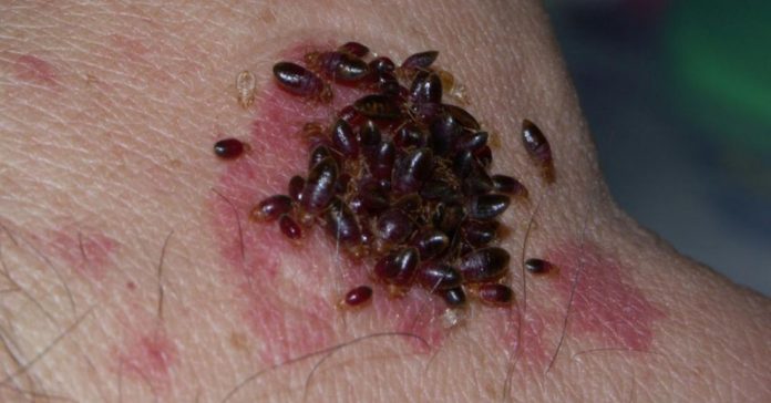 ugrize stjenica